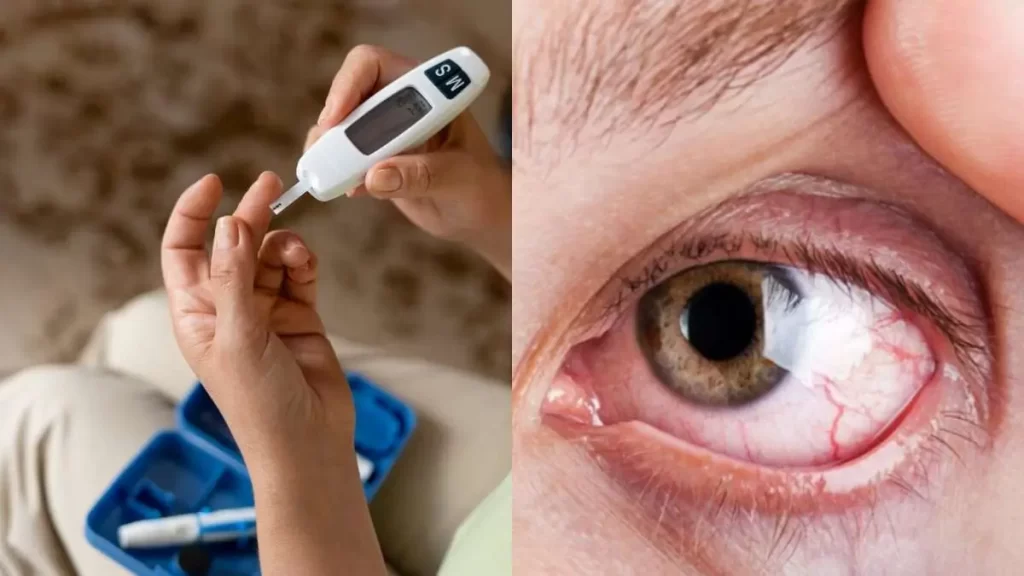 Diabetic retinopathy