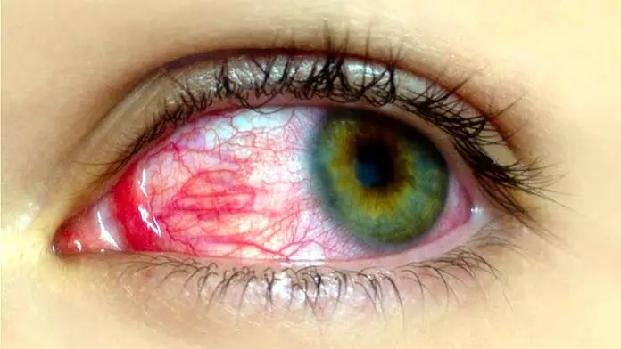 High Blood Pressure Eye