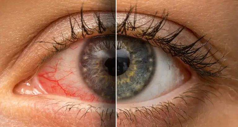 High Blood Pressure Vision