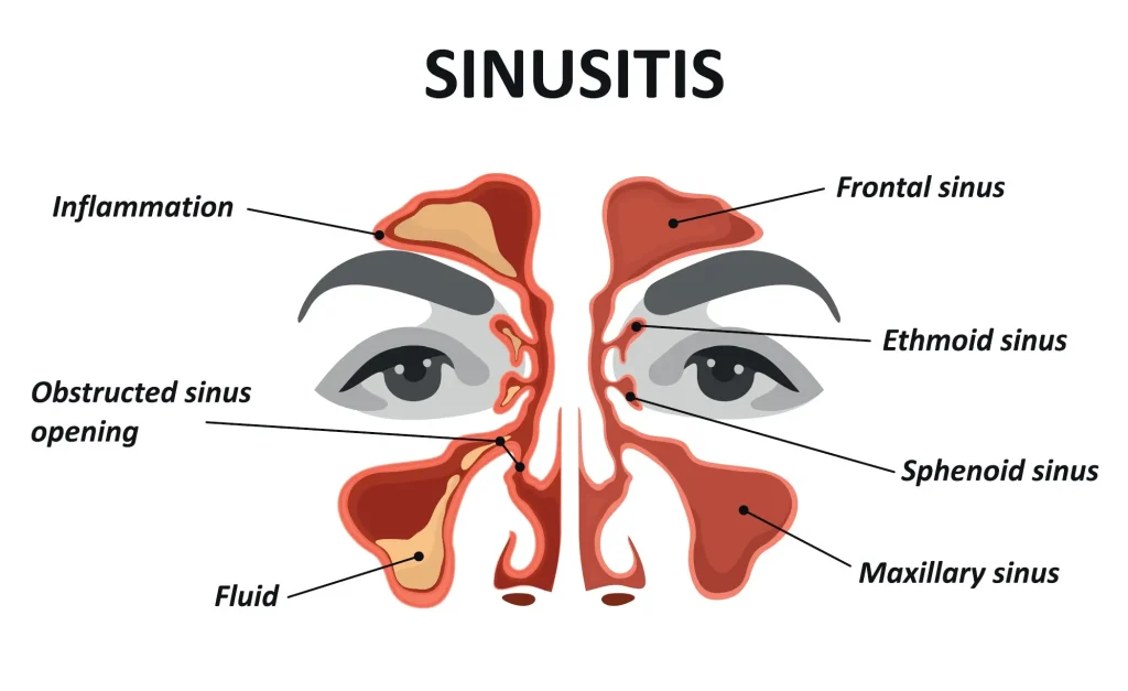 Sinus Issue
