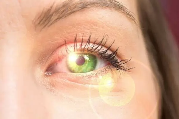 What Is Pterygium