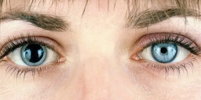 Dilated Pupil
