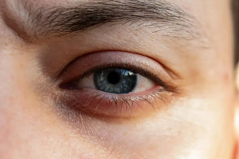 thyroid eye disease